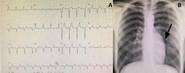 Typical electrocardiogram (A) and chest X-ray (B) of an
asymptomatic 29-year-old patient with congenitally corrected
transposition of the great arteries plus mild tricuspid
regurgitation (arrow=humped appearance).