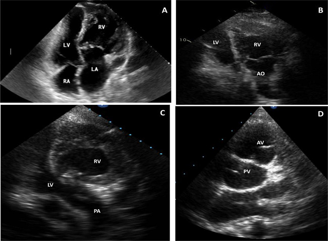 Bidimensional echocardiograms in patients with congenitally
								corrected transposition of the great arteries. A) 16-year-old
								patient, four-chamber view. Discordant atrioventricular connections
								plus moderate tricuspid regurgitation (TR) and mild pulmonary
								stenosis (PS); B) 35-year-old patient, apical view. Left-sided right
								ventricle (RV) connected to aorta (AO) plus mild TR/PS after
								Rastelli operation; C and D) 24-year-old patient with mild TR.
								Apical view (right-sided left ventricle [LV] connected to pulmonary
								artery [PA]) (C) and short axis parasternal view (aortic valve [AV]
								anterior and to the left of pulmonary valve [PV]) (D). LA=left
								atrium; RA=right atrium.