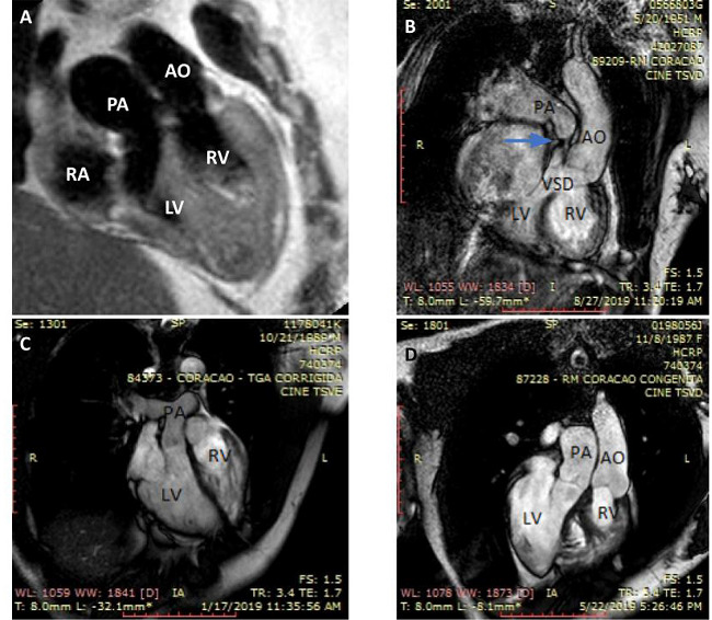Magnetic resonance aspects of four patients with congenitally
corrected transposition of the great arteries. A) Mildly symptomatic
50-year-old patient with moderate-severe tricuspid regurgitation
(TR) showing discordant right-sided atrioventricular connection and
bilateral discordant ventriculoarterial connections; B) symptomatic
69-year-old patient with large ventricular septal defect (VSD) plus
severe pulmonary stenosis (blue arrow); C) asymptomatic 29-year-old
patient with mild TR; D) 31-year-old patient with a mesocardiac
heart after atrial septal defect closure and tricuspid valve
replacement (same patient of Figure
7). AO=aorta; LV=left ventricle; PA=pulmonary artery;
RA=right atrium; RV=right ventricle.