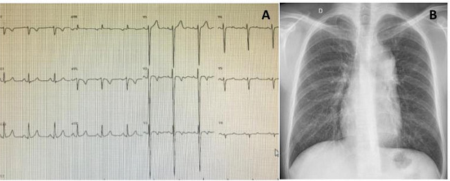 Atypical electrocardiogram (A) and chest radiography (B) of a
34-year-old cyanotic patient with congenitally corrected
transposition of the great arteries + ventricular septal defect +
severe pulmonary stenosis who refused treatment.