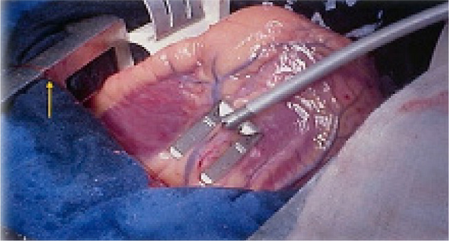 Lima suture developed by Dr. Ricardo Lima allowing to perform
								anastomoses on the posterior wall of the heart and complete
								revascularization.