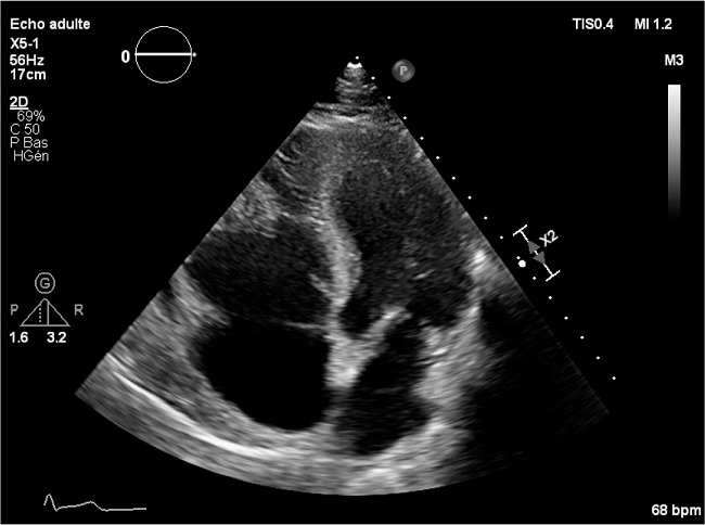 Obliteration of the right ventricle in the apical region, with
							polylobed mass in the right ventricular outflow tract. Note the
							thickened endocardium and the tricuspid annulus dilatation.