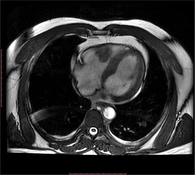 Surgical Management of The Endomyocardial Fibrosis of Right Ventricle