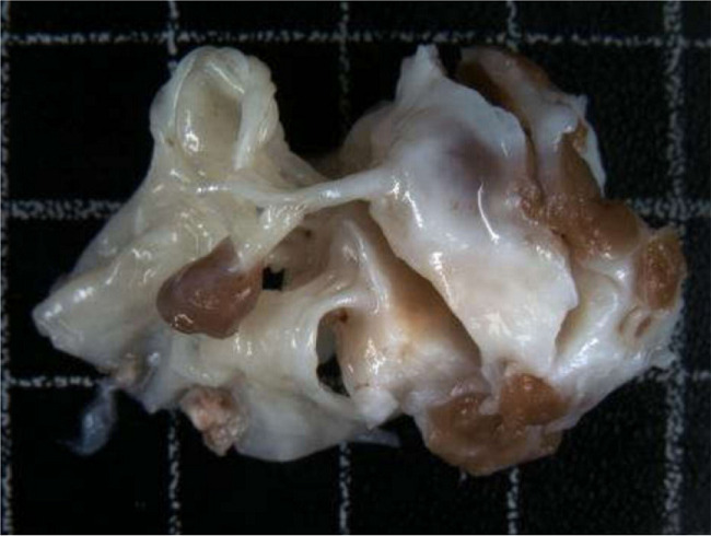 A very thickened and fibrotic endocardium and a tricuspid valve
							leaflet of heterogeneous thickness, with thickened and retracted chordae
							tendineae.