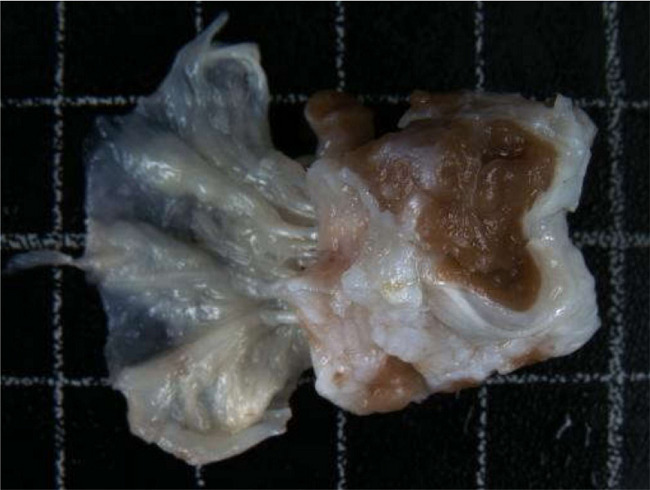 A thickened tricuspid valve leaflet of heterogeneous thickness, with
							thickened and retracted chordae tendineae.