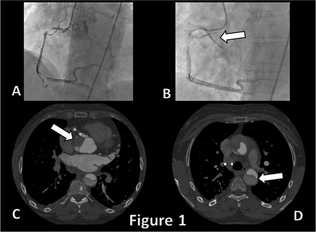Coronary angiogram showing multiple stenosis on the right coronary
							artery and the evidence of aortic wall dissection after stenting (A
							& B, arrow). Axial thoracic computed tomography view showing the
							type A aortic dissection progressing to the descending aorta (C & D,
							arrows).