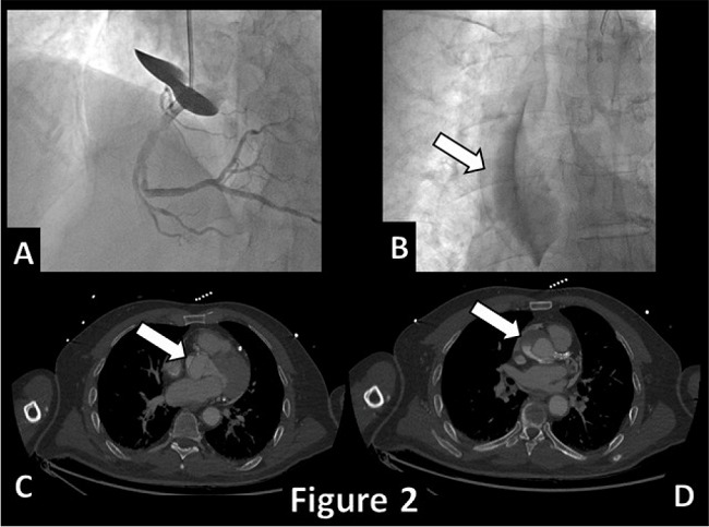 Coronary angiogram with rapid onset and extension of ascending aorta
							dissection (A & B, arrow) confirmed at an urgent computed tomography
							scan (C & D, arrows).