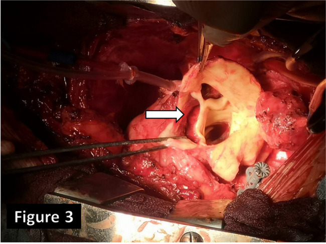 Intraoperative picture. Note the extensive intimal flap within the
							ascending aorta just above the right coronary ostium towards the
							non-coronary sinus (arrow).