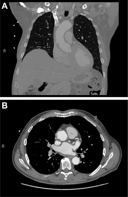Computed tomographic angiograms in the A) coronal and B)
axial views show intimal ulceration of the ascending aorta caused by
a penetrating ulcer. Arrows indicate the
outpouching.