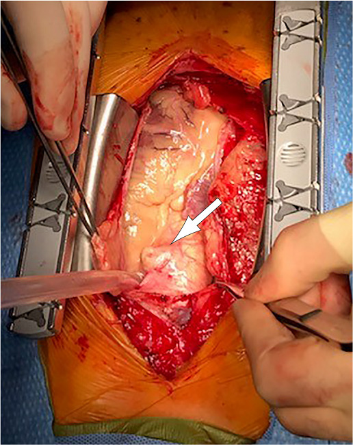 Gross intraoperative image of the ascending aorta
demonstrates one of several outpouchings due to aortic ulceration
with intramural hematoma. Arrow indicates the
outpouching.