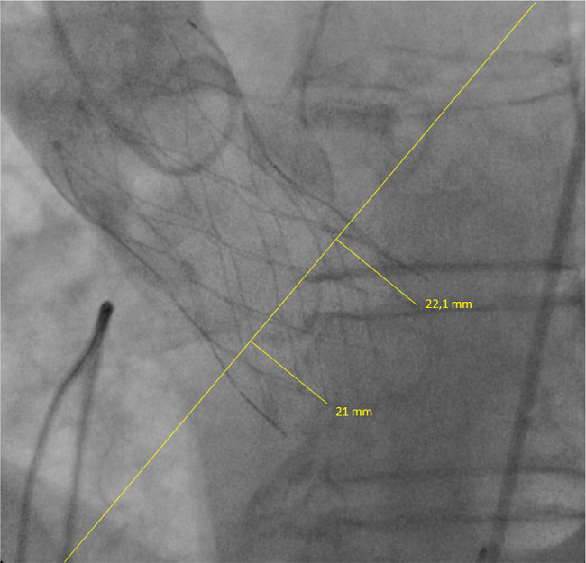 Postoperative aortogram (LAO 12.2&deg;, CRAN 10.1&deg;)
                                with depth implantation metrics for non-coronary and left coronary
                                cusps.