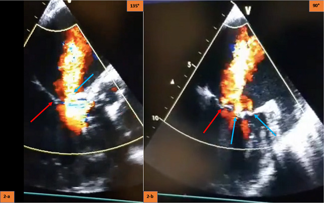 (A) Red arrow shows native mitral valve coaptation line; blue
                                arrow shows anterior mitral valve perforation hole. (B) Red arrow
                                shows native mitral valve coaptation line with mild degree
                                regurgitation; blue arrows show two different holes from anterior
                                mitral valve perforation.