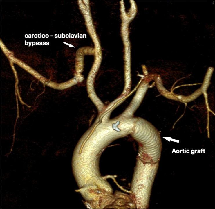 Postoperative control three-dimensional reconstructed computed tomography angiography of open aberrant right subclavian artery resection/ligation and right carotid-subclavian artery bypass.