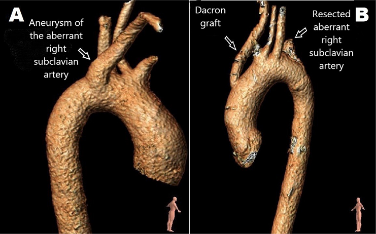 Preoperative (A) and postoperative (B) control three-dimensional reconstructed computed tomography angiography of open aberrant right subclavian artery resection/ligation and ascending aorta-right subclavian artery bypass.
