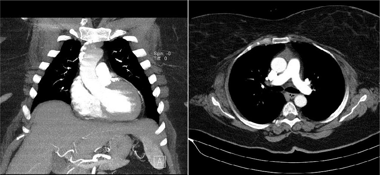 Preoperative computed tomography scan. Patients are suitable
								for this procedure if, at the level of the main pulmonary artery,
								the ascending aorta is rightward.