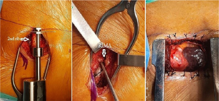 - Exposure of the heart and its vessels.