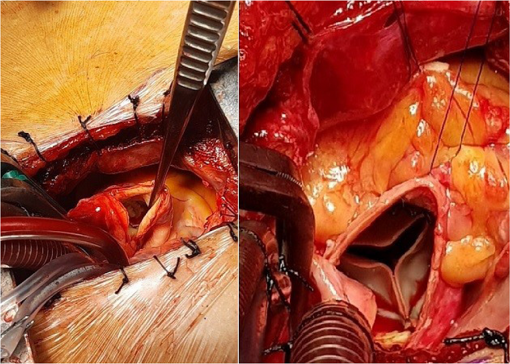 Aortotomy and implantation of the aortic
									prothesis.