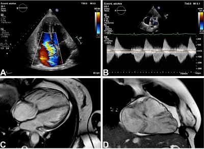 Echocardiography and cardiac magnetic resonance image (MRI) findings. On
transthoracic echocardiography, the patient had severe tricuspid leaflet
thickening causing severe regurgitation (A) and severe pulmonic
regurgitation (B). On cardiac MRI, there is severe right ventricle dilation
(C) and clear absence of valvar coaptation (C, D).