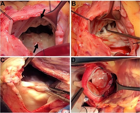 Surgical findings. A) Tricuspid valve with severe retraction of the
anterior and septal leaflets (arrows). B) Severe retraction of the septal
leaflet with thickening of the chordae tendineae. C) Severe retraction of
the pulmonary valve. D) Bioprosthesis in the pulmonary position.