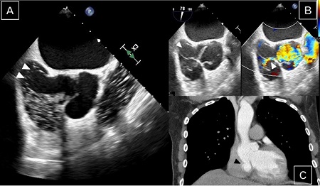 Preoperative transesophageal echocardiography (A, B) and
                        contrast-enhanced computed tomography imaging (C) showing the sinus of
                        Valsalva aneurysm with an aorto-right atrial shunt (arrows).