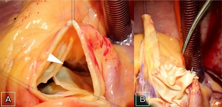 Intraoperative findings of the perforated sinus of Valsalva aneurysm with
                        an aorto-right atrial shunt (arrow) and the asymmetric tricuspid aortic
                        valve configuration (A) and the closure of the right atrial shunt with
                        bovine pericardial patch (B) before aortic valve reimplantation was
                        performed.