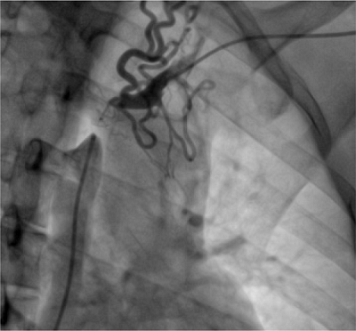 Invasive angiography showing occlusion of the superior vena cava and
                            brachiocephalic vein with collateral circulation.
