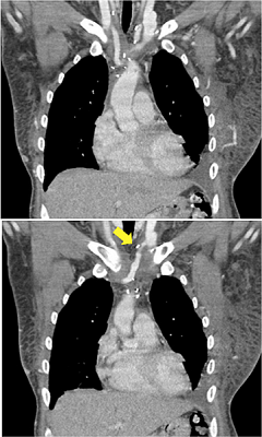 One-year follow-up venous computed tomography angiography images
                            demonstrating complete patency of the right jugular-cava confluent and a
                            20% reduction in the patency of the left branch shunt (arrow).