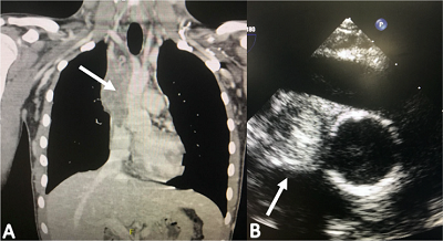 (A) Computed tomography angiography showing thrombosis of the
                            superior vena cava (arrow). (B) Transesophageal echocardiogram images
                            showing 90% occlusion of the superior vena cava circumference
                            (arrow).