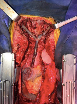 Bilateral internal jugular vein to right atrium bypass with a
                            reversed superficial femoral vein graft.