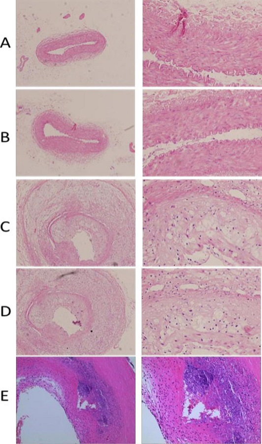 Histopathological changes in the five groups. A, B, C, D, and E
								represent the pure high-fat group, the sham operation group, the
								vulnerable plaque group, the empty load group, and the fat mass and
								obesity-associated gene knockdown group, respectively. From left to
								right, the magnification was 10× and 40×.