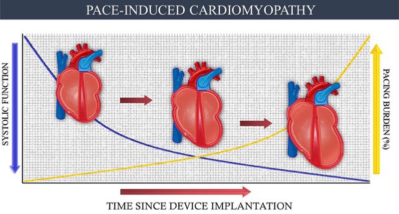 Cardiomyopathy induced by artificial cardiac pacing:
pathophysiological evolution of artificially induced myocardial
ventricular dyssynchrony.