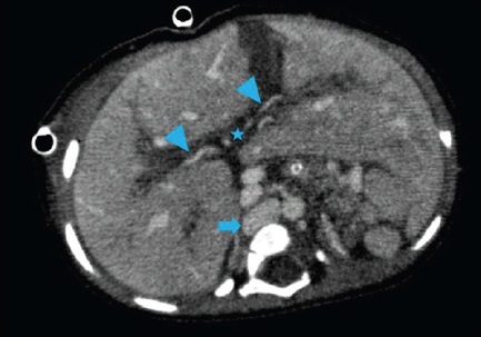 Axial image of the upper hemiabdomen in the venous phase
                                    of computed tomography showing medialized liver, inferior vena
                                    cava (solid arrow) in retrocrural position, cranially bound to
                                    the thoracic cavity with the azygos system. In the liver, the
                                    typical image of the portal vein or its branches is not
                                    identifed at the hilum level (*), identifying only the hepatic
                                    artery and ectatic intrahepatic branches
                                (arrowheads).