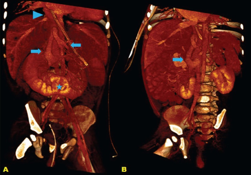 Coronal (A) and oblique (B) three-dimensional
                                    reconstructions of abdominal computed tomography, showing
                                    mesenteric-caval shunt (solid arrows) defning infrahepatic
                                    inferior vena cava engorgement, which continues with the azygos
                                    system at the thoracic level (arrowhead), best seen in A. Also,
                                    horseshoe kidneys (*) fused in the midline anterior to the
                                    abdominal aorta.