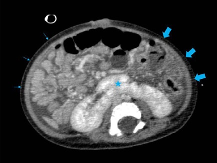 Axial computed tomography image showing horseshoe
                                    kidneys, with inferior poles (*) fused in the midline anterior
                                    to the abdominal aorta. In addition, all segments of small
                                    intestine (smoother walls and smaller caliber) positioned in
                                    their entirety in the right hemiabdomen (thin arrows), while the
                                    colonic segments are identifed only in the left hemiabdomen
                                    (thick arrows), configuring intestinal
                                malrotation.