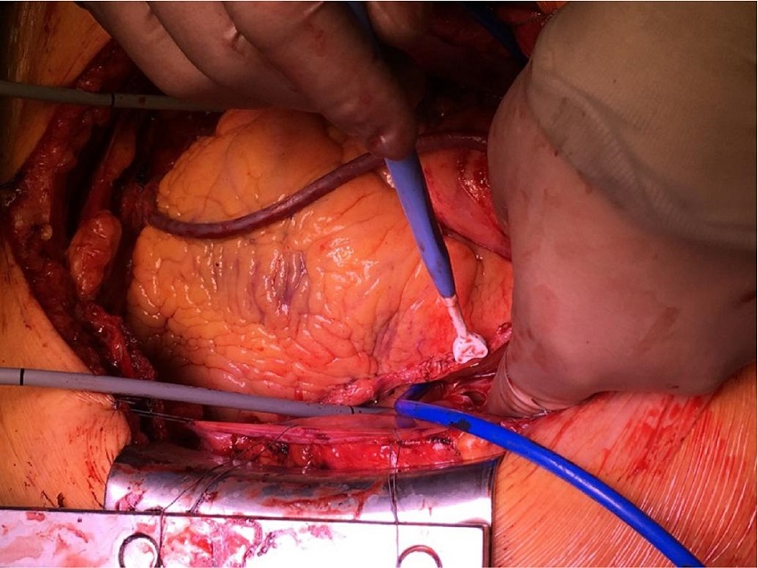 Placement of catheters. Left internal mammary artery flow
								measurement.