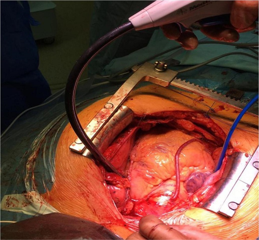 Formation of left half of pulmonary vein encircling
								lesion.