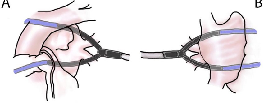 Scheme demonstrating the position of electrodes during the
								ablation. Guiding catheters (blue colour) are attached to
								electrodes.
