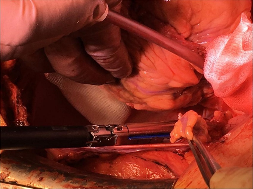 Left atrial appendage resection with a stapler.