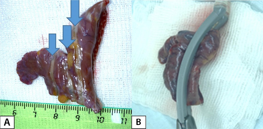 A) Ablation lines (indicated by arrows) on a resected left atrial
								appendage. B) Position of the left atrial appendage in an ablation
								clamp.