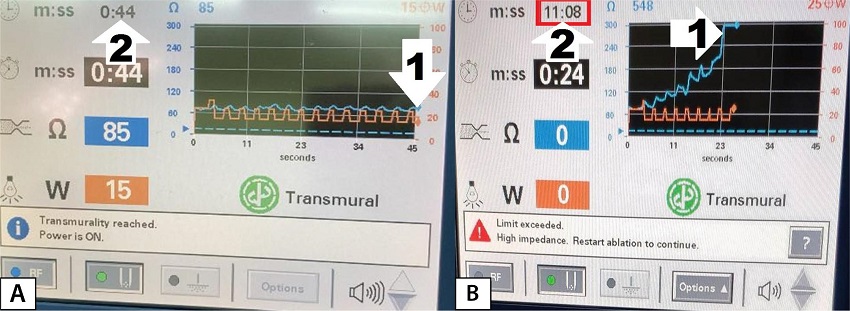 A decrease in the time to transmurality during
										radiofrequency (RF) ablation of the left atrial wall. A)
										First RF application in the series. B) Final RF application.
										1 - achievement of transmurality; 2 - total duration of RF
										application from the time of the first RF application: the
										steady decrease in the time to achieve transmurality is
										obtained.