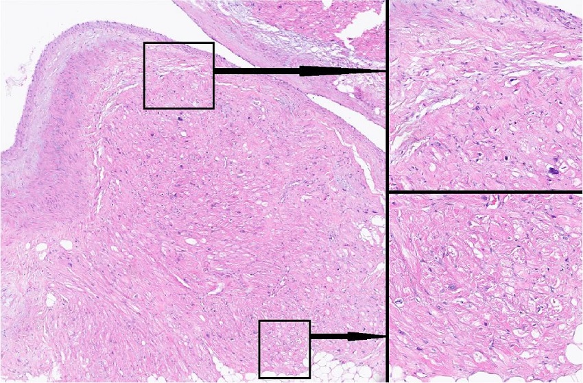 Technique 3 - new technology used for homogeneous scar tissue
								creation. Histological examination of ablation lines. Complete
								ablation line, no intact (viable) cells within the created lesion.
								Micrograph. Staining with hematoxylin and eosin. Magnification &times;125
								(left side of the figure); &times;1000 (right side of the figure).
