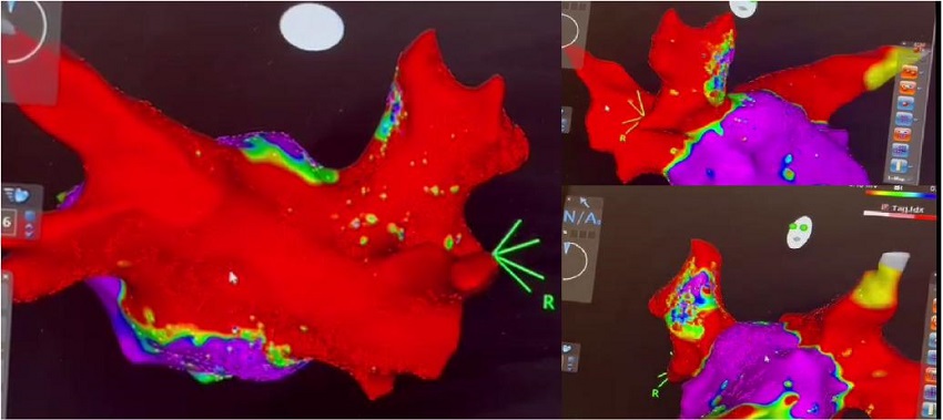 Findings of endocardial electrophysiological examination in a
								patient with recurrent atrial fibrillation. Electrical isolation of
								the pulmonary veins and left atrial posterior wall (marked by
								red).