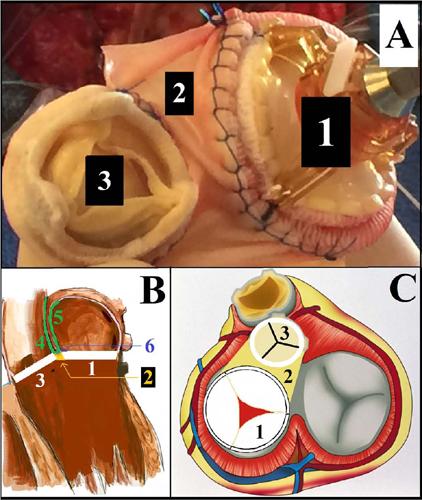 Picture of both valves sutured (A) and illustration of the repair (B
                            and C). 1, mitral prosthesis; 2, pericardial patch between both valves;
                            3, aortic prosthesis; 4-5-6, second pericardial patch with a &ldquo;V shape&rdquo;;
                            4, reconstruction of the aortic wall; 5, reconstruction of the left
                            atrial roof; 6, attachment of the V shape pericardial patch to the
                            monobloc.