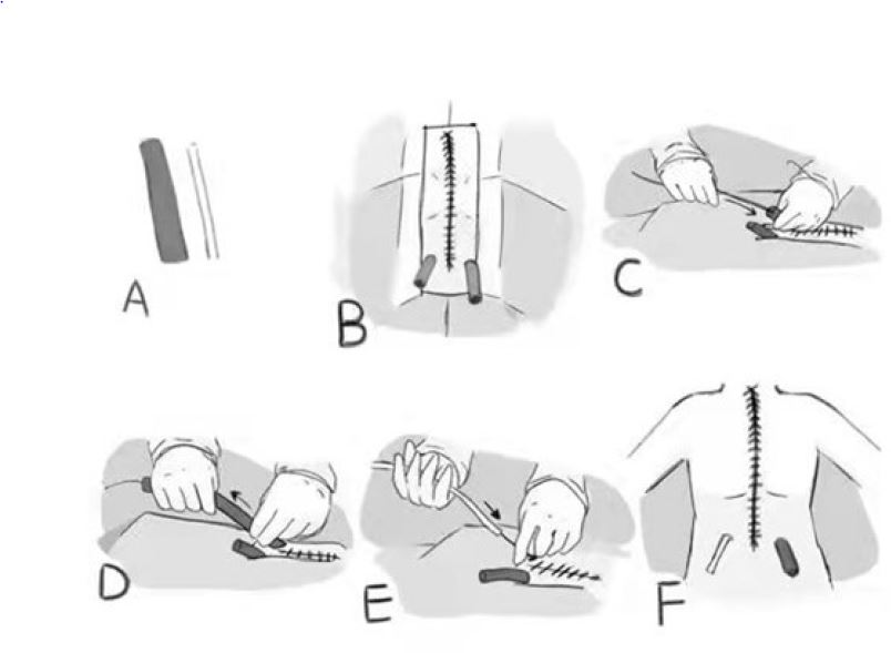 Diagram of the drainage procedure. (A) The left side is a
                                conventional chest and pericardial drainage tube, the right side is
                                a negative pressure groove drainage device catheter. (B)
                                Conventional draping was placed. (C) A 2.6-cm sterile Loach guide
                                wire was placed through the routinely indwelling mediastinal and
                                pericardial rubber drainage tubes during operation. (D) The
                                indwelling pleural drainage tube and pericardial drainage tube were
                                removed. (E) The negative pressure groove drainage tube along the
                                guide wire was placed. (F) Diagram of the same surgical position on
                                left side and right side.