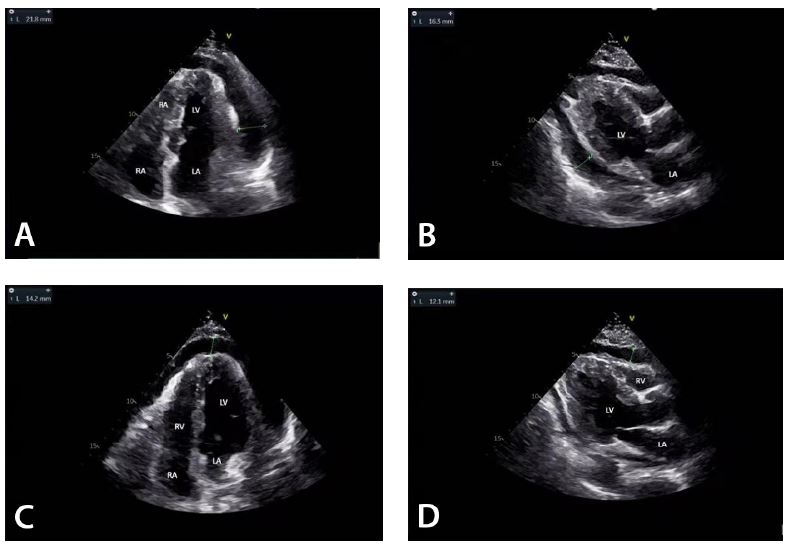 Bedside color Doppler ultrasound was performed to determine the
                                location of effusion and/or associated pericardial thickening. The
                                effusion was mainly located in the posterior wall of left ventricle
                                (LV) (A), left ventricular wall (B), right ventricular wall (C), and
                                cardiac apex (D). LA=left atrium; RA=right atrium; RV=right
                                ventricle.