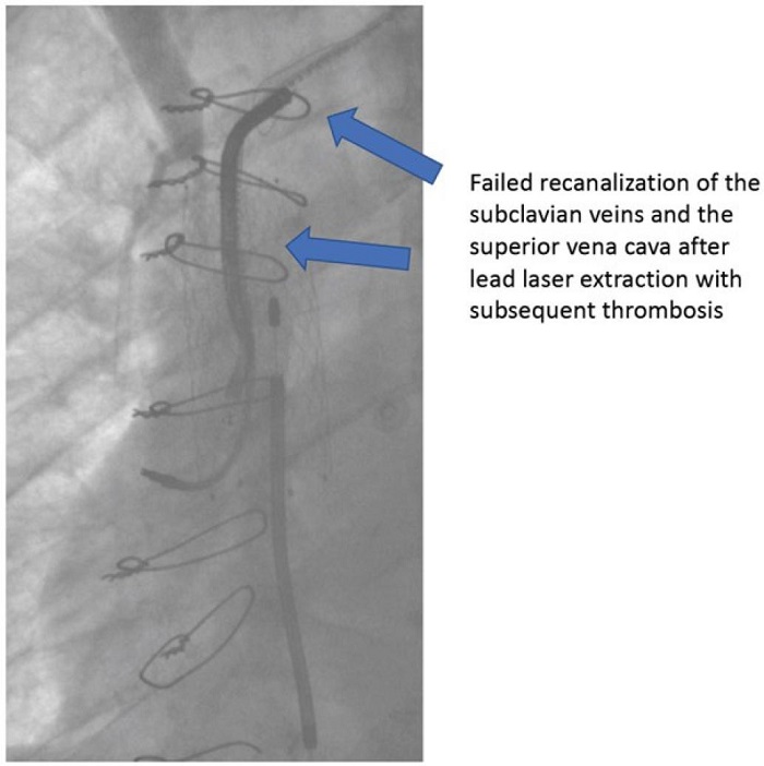 Venography showing rethrombosis of the superior vena cava after
recanalization.