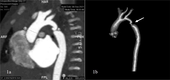 Computed tomography images of a 10-day-old boy with coarctation
								of the aorta. A) Ascending aorta (1); aortic isthmus (2); descending
								aorta at level of diaphragm (3). B) View of the aortic isthmus after
								three-dimensional reconstruction (arrow). ARF=anterior right foot
								position; FPL=foot posterior left position; HAR=head anterior right
								position; PLH=posterior left head position.