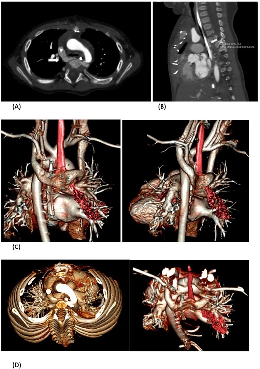 Contrast-enhanced computed tomography showing axial (A) and
								sagittal (B) images of the U-shaped retroesophageal course of left
								brachiocephalic vein (white arrow) which joins the right
								brachiocephalic vein to form the superior vena cava. Volume rendered
								image as seen from posterior aspect (C) and view from the top (D)
								shows abnormal course of left brachiocephalic vein into U- shaped
								vein. (red: trachea).