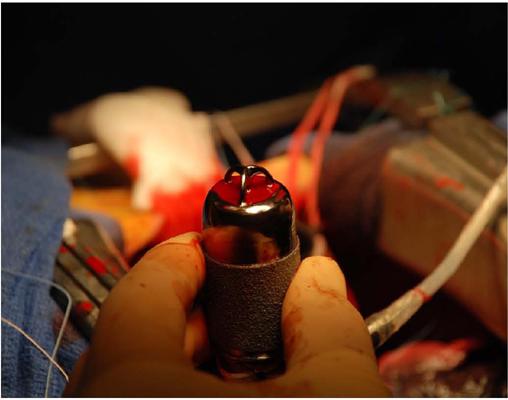 Jarvik® 2000 before implantation.