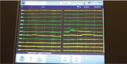 Evidence of ventricular fibrillation in a male speaking patient. Link:
                            https://s3.sa-east-1.amazonaws.com/publisher.gn1.com.br/bjcvs.org/videos/e20210428.mp4